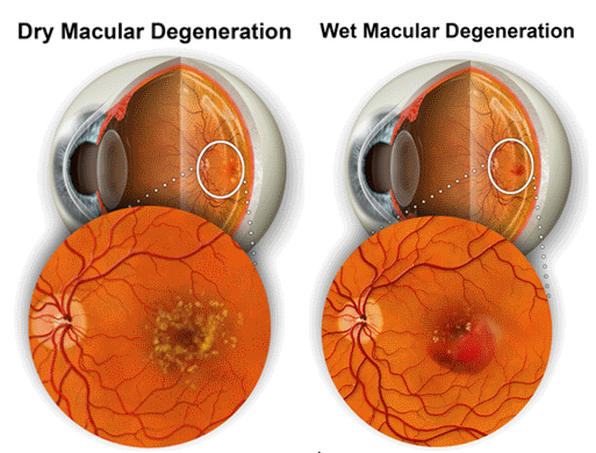 dry-and-wet-age-related-macular-degeneration-1