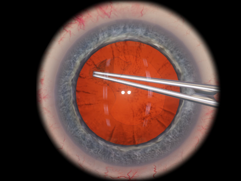 eyesi-capsulorhexis-lev1_orig