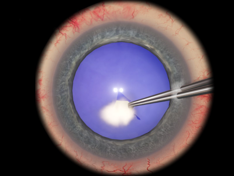 eyesi-capsulorhexis-lev4_orig