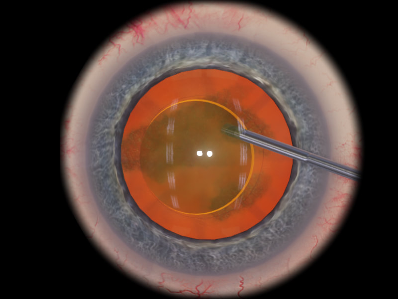 eyesi-hydrodissection_orig