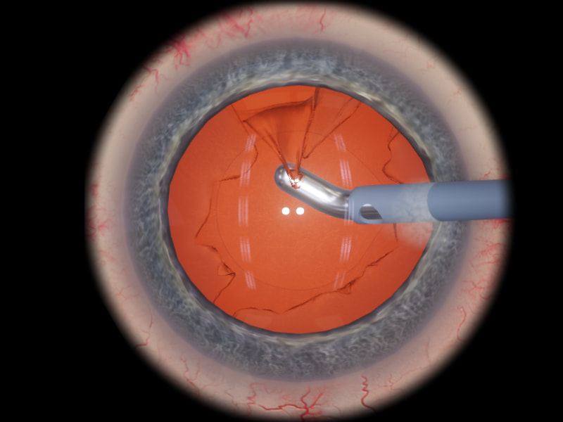 eyesi-irrigationaspiration_orig