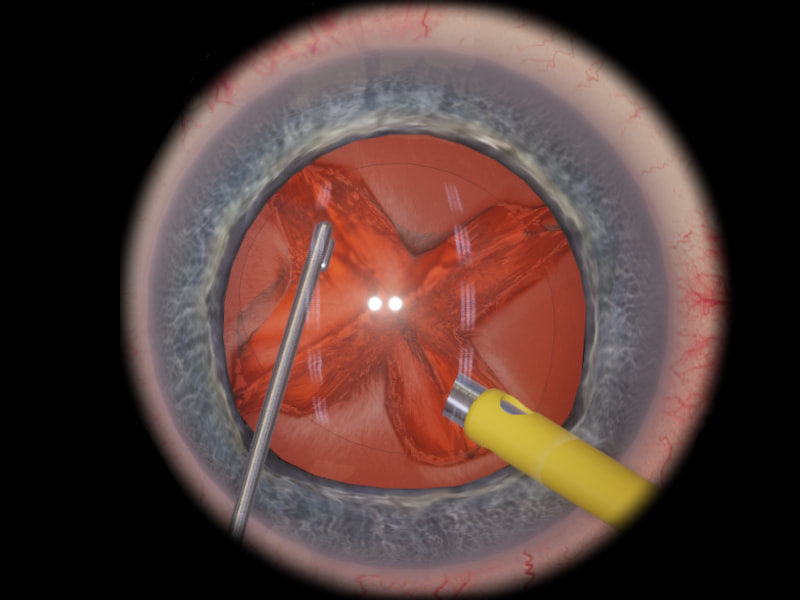 eyesi-phaco_orig
