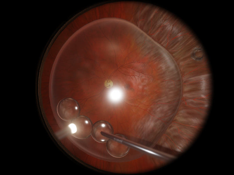 eyesi-retinaldetachment_orig
