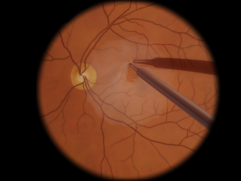 vrt-epiretinalmembrane_orig