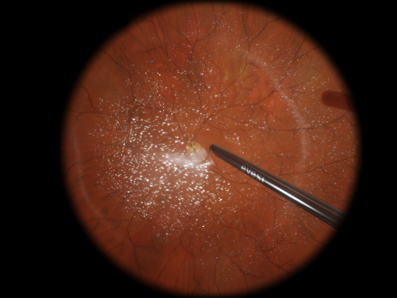 vrt-posterior-hyaloid_orig